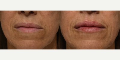 45-54 year old woman treated with Restylane Kysse, Lip Fillers, Restylane, Dermal Fillers - This patient was treated with 1cc of Restylane Kysse. Notice how we were able to symmetrize the top lip, so not only are her lips fuller, but are also now even on both sides. We were also able to define the cupids bow for a more desirable overall lip shape