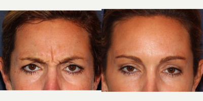 25-34 year old woman treated with Dysport - Woman treated with Dysport injections for fine lines and wrinkles to the glabella.
