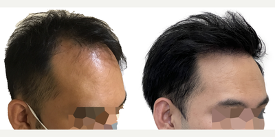 39 year old man treated with FUE Hair Transplant, Minoxidil and Low-Level Laser Therapy (BIOLIGHT Laser Cap) - This is a 39-year-old male who came to us with a history of hair loss spanning more than 10 years, starting in his late 20s. At the time of his consultation, he was not on any medications or taking any steps to slow or stop his hair loss. There was a strong family history of hair loss in his father and maternal grandfather. What bothered him most was the thinning in the frontal scalp as well as the appearance of a very deep widows peak on both sides of the hairline. You can see in the frontal view that, with the extent of thinning, you can see almost as far back as the mid-scalp. He was seeking a more youthful hairline with added density in the frontal scalp. This was his first surgery. He had a 1500 graft FUE to rebuild the hairline and add density behind it in the frontal scalp. Being close to 40 years old he wanted the resulting shape and density to appear as natural as possible. We used an irregularly irregular scalloped design to mimic the natural appearance of a hairline, focussing on density in the nearly empty areas just behind the hairline. Additional density was placed behind that. At the same time, he was started on a preventive regimen of high-strength minoxidil and the BIOLIGHT laser cap to prevent any more ongoing hair loss. He returned to us 11 months after his surgery with amazing results and hes very happy! The widows peak has been softened and weve been able to maintain natural, masculine corners in the fronto-temporal angles (where the front hairline meets the side hairline). There is enough density in the frontal scalp that you cant see through it to the mid-scalp behind anymore. The donor area looks amazing and you cant tell that any grafts have been extracted from that area. In fact, nobody who just met him would be able to tell that hes had any hair transplant surgery at all! The supplementary therapies (minoxidil and laser cap) have worked really well so far to help him keep the hair he still has, and theres been no progression of his hair loss in other areas. We discussed a long-term maintenance strategy and hes going to continue with his high-strength minoxidil and BIOLIHT laser cap indefinitely. If he ever decides to seek just a little added density in the crown, we discussed the possibility of starting platelet-rich plasma (PRP).