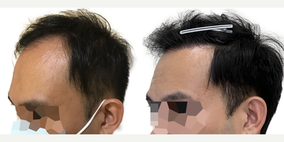 39 year old man treated with FUE Hair Transplant, Minoxidil and Low-Level Laser Therapy (BIOLIGHT Laser Cap) - This is a 39-year-old male who came to us with a history of hair loss spanning more than 10 years, starting in his late 20s. At the time of his consultation, he was not on any medications or taking any steps to slow or stop his hair loss. There was a strong family history of hair loss in his father and maternal grandfather. What bothered him most was the thinning in the frontal scalp as well as the appearance of a very deep widows peak on both sides of the hairline. You can see in the frontal view that, with the extent of thinning, you can see almost as far back as the mid-scalp. He was seeking a more youthful hairline with added density in the frontal scalp. This was his first surgery. He had a 1500 graft FUE to rebuild the hairline and add density behind it in the frontal scalp. Being close to 40 years old he wanted the resulting shape and density to appear as natural as possible. We used an irregularly irregular scalloped design to mimic the natural appearance of a hairline, focussing on density in the nearly empty areas just behind the hairline. Additional density was placed behind that. At the same time, he was started on a preventive regimen of high-strength minoxidil and the BIOLIGHT laser cap to prevent any more ongoing hair loss. He returned to us 11 months after his surgery with amazing results and hes very happy! The widows peak has been softened and weve been able to maintain natural, masculine corners in the fronto-temporal angles (where the front hairline meets the side hairline). There is enough density in the frontal scalp that you cant see through it to the mid-scalp behind anymore. The donor area looks amazing and you cant tell that any grafts have been extracted from that area. In fact, nobody who just met him would be able to tell that hes had any hair transplant surgery at all! The supplementary therapies (minoxidil and laser cap) have worked really well so far to help him keep the hair he still has, and theres been no progression of his hair loss in other areas. We discussed a long-term maintenance strategy and hes going to continue with his high-strength minoxidil and BIOLIHT laser cap indefinitely. If he ever decides to seek just a little added density in the crown, we discussed the possibility of starting platelet-rich plasma (PRP).