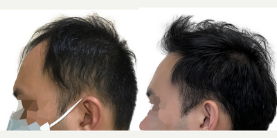 39 year old man treated with FUE Hair Transplant, Minoxidil and Low-Level Laser Therapy (BIOLIGHT Laser Cap) - This is a 39-year-old male who came to us with a history of hair loss spanning more than 10 years, starting in his late 20s. At the time of his consultation, he was not on any medications or taking any steps to slow or stop his hair loss. There was a strong family history of hair loss in his father and maternal grandfather. What bothered him most was the thinning in the frontal scalp as well as the appearance of a very deep widows peak on both sides of the hairline. You can see in the frontal view that, with the extent of thinning, you can see almost as far back as the mid-scalp. He was seeking a more youthful hairline with added density in the frontal scalp. This was his first surgery. He had a 1500 graft FUE to rebuild the hairline and add density behind it in the frontal scalp. Being close to 40 years old he wanted the resulting shape and density to appear as natural as possible. We used an irregularly irregular scalloped design to mimic the natural appearance of a hairline, focussing on density in the nearly empty areas just behind the hairline. Additional density was placed behind that. At the same time, he was started on a preventive regimen of high-strength minoxidil and the BIOLIGHT laser cap to prevent any more ongoing hair loss. He returned to us 11 months after his surgery with amazing results and hes very happy! The widows peak has been softened and weve been able to maintain natural, masculine corners in the fronto-temporal angles (where the front hairline meets the side hairline). There is enough density in the frontal scalp that you cant see through it to the mid-scalp behind anymore. The donor area looks amazing and you cant tell that any grafts have been extracted from that area. In fact, nobody who just met him would be able to tell that hes had any hair transplant surgery at all! The supplementary therapies (minoxidil and laser cap) have worked really well so far to help him keep the hair he still has, and theres been no progression of his hair loss in other areas. We discussed a long-term maintenance strategy and hes going to continue with his high-strength minoxidil and BIOLIHT laser cap indefinitely. If he ever decides to seek just a little added density in the crown, we discussed the possibility of starting platelet-rich plasma (PRP).