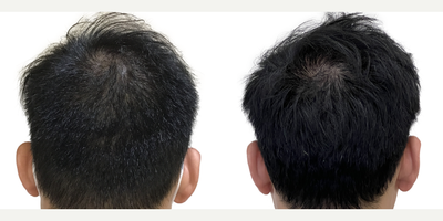 39 year old man treated with FUE Hair Transplant, Minoxidil and Low-Level Laser Therapy (BIOLIGHT Laser Cap) - This is a 39-year-old male who came to us with a history of hair loss spanning more than 10 years, starting in his late 20s. At the time of his consultation, he was not on any medications or taking any steps to slow or stop his hair loss. There was a strong family history of hair loss in his father and maternal grandfather. What bothered him most was the thinning in the frontal scalp as well as the appearance of a very deep widows peak on both sides of the hairline. You can see in the frontal view that, with the extent of thinning, you can see almost as far back as the mid-scalp. He was seeking a more youthful hairline with added density in the frontal scalp. This was his first surgery. He had a 1500 graft FUE to rebuild the hairline and add density behind it in the frontal scalp. Being close to 40 years old he wanted the resulting shape and density to appear as natural as possible. We used an irregularly irregular scalloped design to mimic the natural appearance of a hairline, focussing on density in the nearly empty areas just behind the hairline. Additional density was placed behind that. At the same time, he was started on a preventive regimen of high-strength minoxidil and the BIOLIGHT laser cap to prevent any more ongoing hair loss. He returned to us 11 months after his surgery with amazing results and hes very happy! The widows peak has been softened and weve been able to maintain natural, masculine corners in the fronto-temporal angles (where the front hairline meets the side hairline). There is enough density in the frontal scalp that you cant see through it to the mid-scalp behind anymore. The donor area looks amazing and you cant tell that any grafts have been extracted from that area. In fact, nobody who just met him would be able to tell that hes had any hair transplant surgery at all! The supplementary therapies (minoxidil and laser cap) have worked really well so far to help him keep the hair he still has, and theres been no progression of his hair loss in other areas. We discussed a long-term maintenance strategy and hes going to continue with his high-strength minoxidil and BIOLIHT laser cap indefinitely. If he ever decides to seek just a little added density in the crown, we discussed the possibility of starting platelet-rich plasma (PRP).