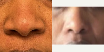 35-44 year old woman treated with African American Rhinoplasty - 37 year old female underwent Alarplasty surgery under local anesthesia.