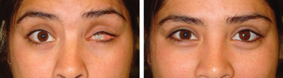 Prosthetic Eye - 	Before (left) and after (right) prosthetic eye (after enucleation/eye removal).