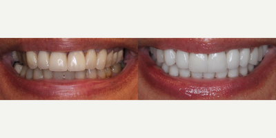Woman treated with Tooth Repair - Woman treated with Tooth Repair through full mouth reconstruction. Patient had replacement of old crowns and 28 porcelain restorations using veneers as well as fixing of posterior crossbite (notice how the patients upper right side was deficient and had negative space) and masking an overbite.