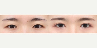 25-34 year old woman treated with Eyelid Surgery, Double Eyelid Surgery, Canthoplasty - She had incisional eyelid/double eyelid with ptosis correction, epicanthoplasty