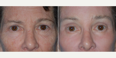 Woman treated with Eyelid Surgery - Woman treated with Facelift, CO2 Laser for wrinkle removal, Eyelid Surgery, as well as Brow Lift.