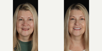 Woman treated with Dental Crown - Treatment: 10 upper and 10 lower restorations using veneers and dental crowns.