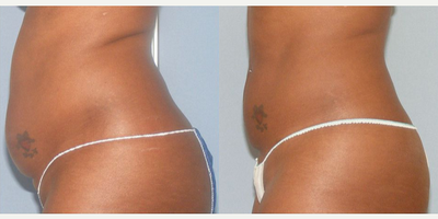 UltraShape - Photos provided courtesy of Syneron & Candela, performed by Christopher J. Inglefield, MBBS, FRCS