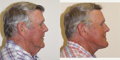 65-74 year old man treated with Neck Lift - This gentleman, 72 years old, complained of a significant turkey neck. He underwent an anterior direct neck lift with adjacent neck liposuction and platysmaplasty. 