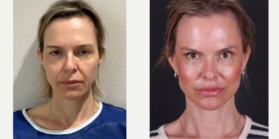 55-64 year old woman treated with Facelift, Neck Lift, Brow Lift, Ptosis Surgery, Eyelid Surgery - 55-64 year old woman treated with Facelift, Neck Lift, Brow Lift, Ptosis Surgery, Eyelid Surgery