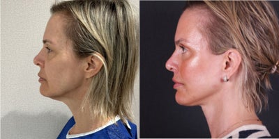 55-64 year old woman treated with Facelift, Neck Lift, Brow Lift, Ptosis Surgery, Eyelid Surgery - 55-64 year old woman treated with Facelift, Neck Lift, Brow Lift, Ptosis Surgery, Eyelid Surgery