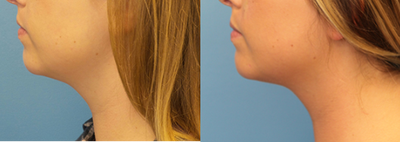25-34 year old woman treated with Kybella - This patient was concerned with a lack of definition under her chin. She was treated with Kybella.