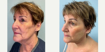 65-74 year old woman treated with Neck Lift, Facelift, Renuvion, MyEllevate - This case involves a 69-year-old female patient who underwent a MyEllevate, Renuvion, facelift, and neck lift procedure. The post-operative results were documented two months following the surgery. Tumescent fluid was then infiltrated into the subcutaneous space of the face and neck; 500 ccs per side. The before-and-after images display observable changes in the jawline and neck area. In the after photo, there is a notable reduction in skin laxity around the neck and a more defined jawline contour compared to the pre-operative image. The skin texture appears smoother and more uniform. These outcomes reflect typical physical adjustments associated with these procedures within the given timeframe. This description is based solely on visible changes noted in the photographs provided without implying future results or patient satisfaction.