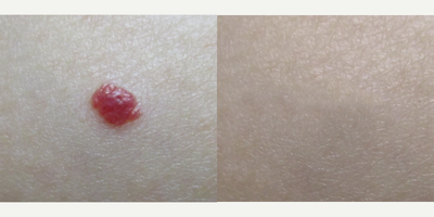 18-24 year old woman treated with Mole Removal - 24-year-old female before, after 1 and after 2 laser hemangioma treatments.  Patient was very happy with complete removal and no scarring.