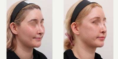 25-34 year old woman treated with Nonsurgical Facelift, AccuLift, Liposuction - Chief Complain: uneven face lines, hollowed under eyes, chubby cheeks, squared face shapeTreatment Plan: facial fat graft, under eye fat reposition, face liposuction ( cheeks, double chine, zygomatic angle) Outcome: - smooth V-lined face line - younger and refreshed look