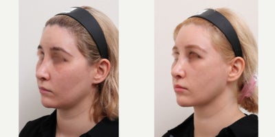 25-34 year old woman treated with Nonsurgical Facelift, AccuLift, Liposuction - Chief Complain: uneven face lines, hollowed under eyes, chubby cheeks, squared face shapeTreatment Plan: facial fat graft, under eye fat reposition, face liposuction ( cheeks, double chine, zygomatic angle) Outcome: - smooth V-lined face line - younger and refreshed look