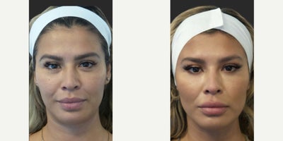 Woman treated with Nonsurgical Facelift - Elevate your natural beauty with the Contour Lift-Face. Achieve stunning, long-lasting results without the scars or downtime.