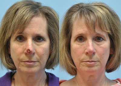 56 year old woman treated for skin cancer defect - Full thickness skin graft