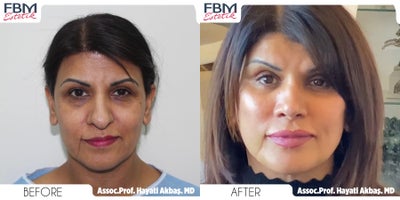 45-54 year old woman treated with Deep Plane Facelift, Facial Fat Transfer, Double Eyelid Surgery, Neck Lift, Rhinoplasty - 45-54 year old woman treated with Deep Plane Facelift, Facial Fat Transfer, Double Eyelid Surgery, Neck Lift, Rhinoplasty