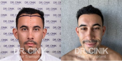 35-44 year old nonbinary person treated with FUE Hair Transplant - 37 Years Old Male Patient - Norwood III - 3450 Grafts