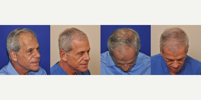 55-64 year old man treated with Hair Transplant - FUT linear strip method 2.564 follicles - Dr. Beaumont is a 64 year old physician who had concerns that his hair loss made him look older than he was. He didnt like how the absence of a frontal hairline made him look, and how others would let their eyes drift up to his hair loss while they were talking to him. He felt his patients were responding to him differently as well. After doing some 3 years of research on hair restoration surgery, Dr. Beaumont underwent a hair restoration surgery, FUT linear strip, with 2,564 follicles transplanted in March of 2016. In March of 2017 he returned for his post-operative photos, and was thrilled with his new look. He says that patients and friends tell him he looks great, and their eyes no longer drift up to where his hairline used to be.
