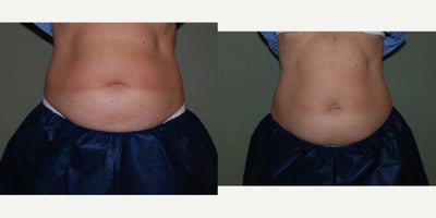 CoolSculpting - Cool sculpting one treatment of lower abdomen 3 months later