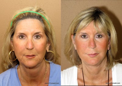Mid face and face lift  fat transfer to the face - 
	Mid facelift and facelift procedure combined with fat transfer - performed by Chicago plastic surgeon Dr Turowski - see testimony on our site
