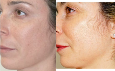 45-54 year old woman treated with DefenAge - 45-54 year old woman treated with DefenAge