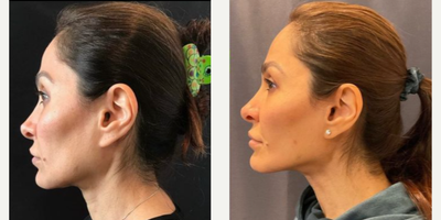 Woman treated with Nonsurgical Facelift - EMFACE Before & After of our very own Dr. Deborah Marciano! Noninvasive and No Downtime!