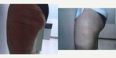 35-44 year old man treated with Skin Rejuvenation Body Fx & Body Plus - Female addressing cellulite and loose skin. Completed 6 sessions of Body Fx, fat reduction, and Body Plus, skin tightening.