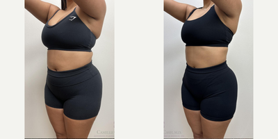 Semaglutide for weight loss with Evolve Transform treatments for proactive skin tightening - This patient is seen here before and 27 weeks later.During her once weekly rounds of my #CashedOut Semaglutide Weight Loss program, which also includes a separate B-12 injection for energy, she received EvolveX Transform body sculpting treatments. These hands-free, pain-free treatments combine the benefits of radiofrequency (RF) energy and electrical muscle stimulation (EMS) to sculpt, tone, and tighten various areas of the body. It targets stubborn fat, enhances muscle definition, and improves skin elasticity, offering a comprehensive solution for body transformation without surgery or downtime. We especially love this treatment for Semaglutide patients since they can be safely performed throughout ones weight loss journey as a proactive measure against loose skin caused by rapid volume loss, a common concern known in pop-culture as Ozempic Butt.She is seen here before and 27 weeks after starting our Semaglutide weight loss program. At 51, her weight loss from 176 to 155 significantly reduced her BMI from 33.3 (obesity range) to a much healthier BMI of 29.4.