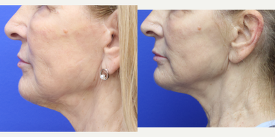 65-74 year old woman treated with Ellacor - 69 year old woman 7 weeks post One Ellacor treatment to the midface and central/upper neck. She has noticed improved fine lines of the mouth, cheek, along the jaw line as well as improvement in the crepiness of the neck skin.