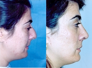 Rhinoplasty - Patient disliked her large bump and the appearance of the tip pointing down