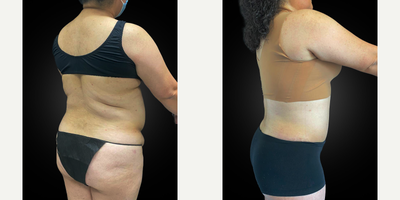 45 year old female treated with Lymphatic Massage - 45 year old female who underwent a tummy tuck with diastasis recti repair, VASER liposuction and Renuvion J Plasma skin tightening of her upper/middle/lower back, flanks, medial thighs and neck, and BBL (Brazilian Butt Lift/fat transfer to the buttocks), three months prior.
