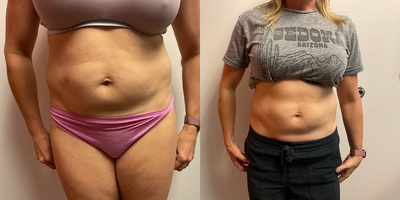35-44 year old woman treated with Cryoskin - Cryoskin body contouring for slimming and toning! 4/5 treatments!