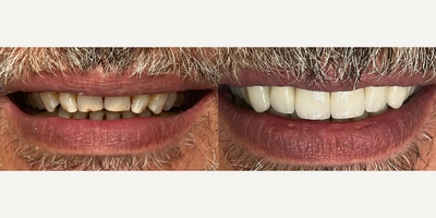 45-54 year old man treated with Lumineers - We planned a smile makeover for our patient. We treated office bleaching in 2 hours. We applied e-max lumineer in 6 days and e-max onlay filling in 3 days.
