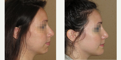 18-24 year old woman treated with Chin Implant through the intraoral approach - This young woman desired facial enhancement - we decided to perform chin enhancement - augmentation through the intraoral approach (my preferred method although more difficult for some surgeons I like it since it leaves no outside scars). We combined it with a rhinoplasty for more enhanced but subtle natural  effect