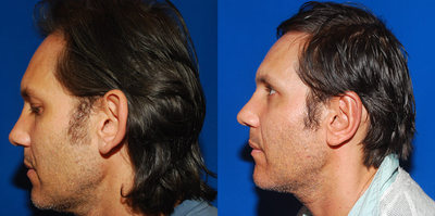 Ear Surgery - Ear Surgery