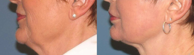 55-64 year old woman treated with Laserlift - Laserlift is a non-surgical treatment that heats deep layers of skin for a more youthful look. The results speak for themselves.