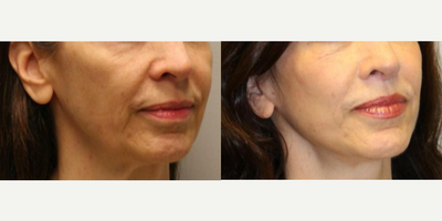 Woman treated with Lip Surgery - Woman treated with Lip Surgery through Lip Lift