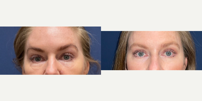 45-54 year old woman treated with Eyelid Surgery, Sofwave - Patient desired eyelid surgery (upper blepharoplasty) to help with eyelid droop that comes with age. Dr. Haydon also used SofWave (ultrasound radiofrequency technology) on lower eyes to help with tightening and minimizing wrinkles. Great results!
