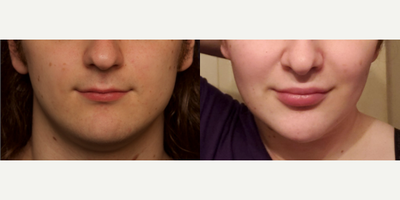 Patient treated with MTF Chin Surgery - Patient treated with MTF Chin Surgery for reduction and contouring