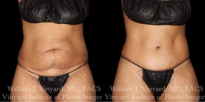 35-44 year old woman treated with Diastasis Recti Repair, Mommy Makeover, Tummy Tuck - This patient underwent a full abdominoplasty with rectus muscle repair, umbilicoplasty, and a mons pubis lift to restore a smoother, tighter, and more balanced abdominal contour.By removing the lax lower-abdominal skin and tightening the underlying musculature, Dr. Vinyard created a firmer, flatter profile with significantly improved definition through the waistline. Her new belly button was meticulously designed to appear natural and proportional to her torso, avoiding the surgical look patients often worry about.The incision was placed low and kept exceptionally thin so it remains easily hidden beneath minimal clothing  a hallmark of Dr. Vinyards technique. Overall, she now has a more sculpted silhouette with enhanced abdominal shape, improved core support, and a noticeably rejuvenated lower abdomen and mons area.