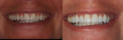 Minimal prep veneers  - Goals: 
+ whiter smile
+ more symmetric
+ less gummy smile

We did some no prep to minimal prep veneers on this patient.  Did a slight laser gum lift.  Used super thin Glass veneers.  Gave her a well balanced and complimentary color.