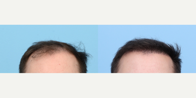 18-24 year old man treated with FUE Hair Transplant, Hair Transplant, Hair Loss Treatment, PRP for Hair Loss, PRP Injections - At 24 years old, this patient sought to increase their hair density and strengthen their hairline. Dr. Wise performed an FUE hair transplant procedure using 3,850 grafts and one session of PRP therapy. Significant results were noticeable six months post-surgery.