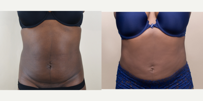 25-34 year old woman treated with Liposuction - This patient wanted liposuction of her abdomen to remove exercise-resistant fat.