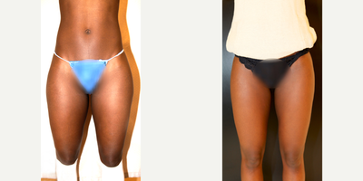 29 year old woman treated with Liposuction - This female patient aged 29 was treated with a thigh liposuction. The after photo was taken 5 weeks after surgery.