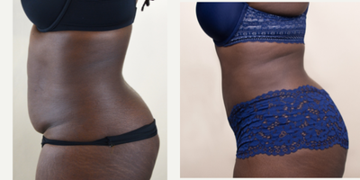 25-34 year old woman treated with Liposuction - This patient wanted liposuction to treat exercise-resistant fat.