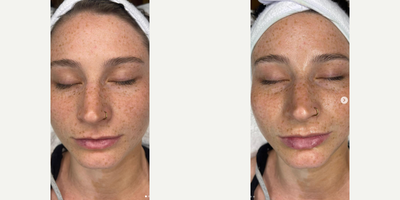 Woman treated with Dermaplaning - Dermaplaning is one of our favorite treatments, that can be added on to other facials or stand alone!Not only is it removing the vellus hair (peach fuzz) but it also exfoliates the first layer of skin to ensure products absorb better!During this treatment you can expect a nice cleaning and hydration mask with massage, to leave you relaxed and glowing!